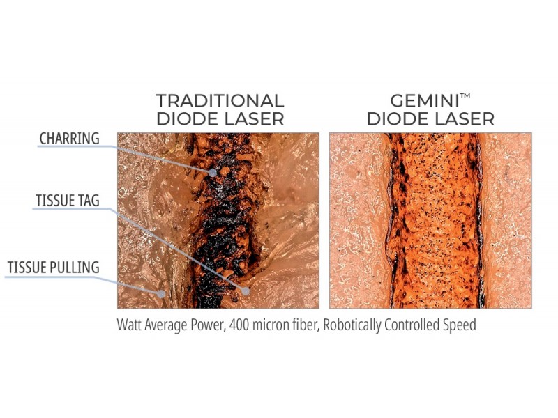 Gemini 7mm Uninitiated Tips Gemini Laser